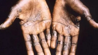 monkeypox